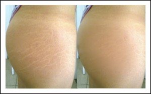 estrias-antes e depois